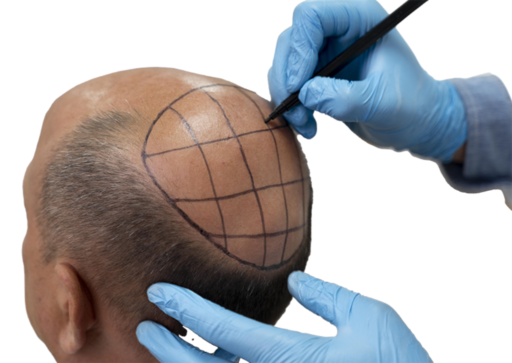 Hair Transplant Turkey: The Ultimate 2025 Guide to Amazing Results 1 A patient undergoing a FUE hair transplant in Turkey at a top clinic.