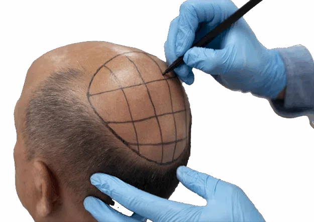 Premium FUE Hair Transplant Package – 5000 Grafts