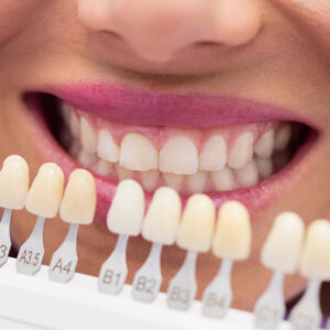 Hollywood Smile Makeover Package