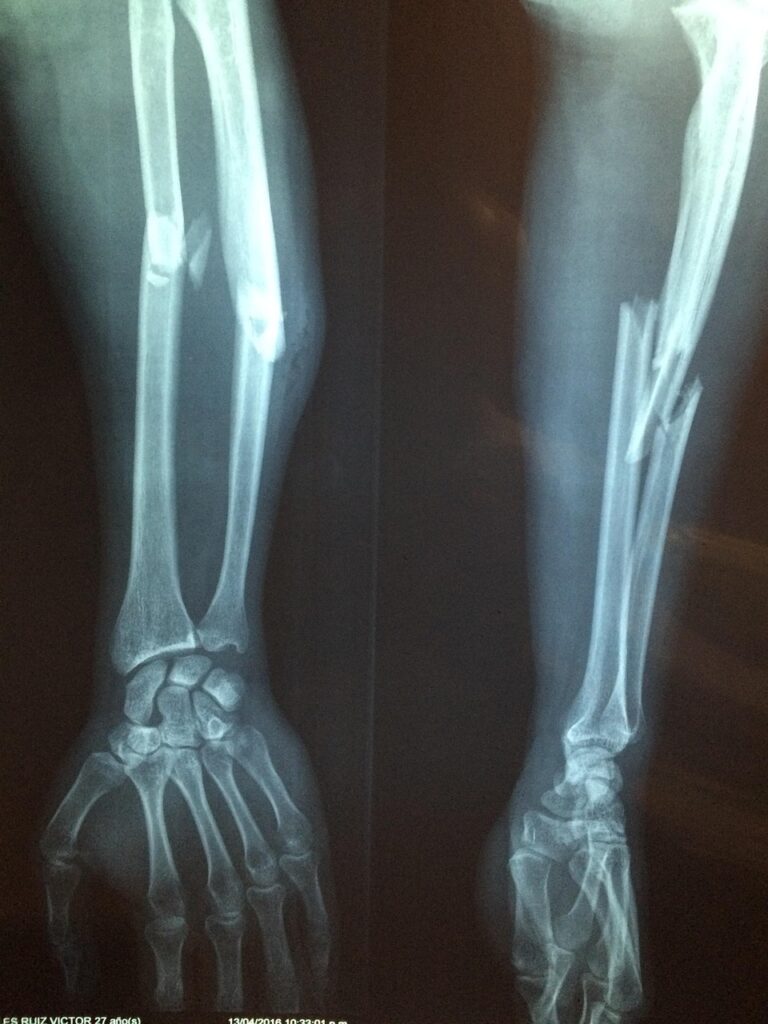 Medical Tourism in Turkey – Compare & Book the Best Hospitals 7 fracture-bone-2333164_1280