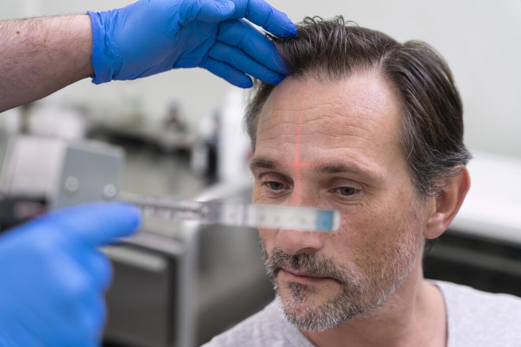 Hair Transplant Turkey: The Ultimate 2025 Guide to Amazing Results 2 A patient hair checkup after hair transplant in Turkey at a top clinic.