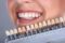 Exclusive Full Mouth Reconstruction Package