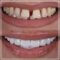 Exclusive Full Mouth Reconstruction Package